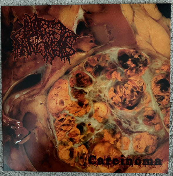 Blasted Pancreas – Carcinoma 🇺🇸